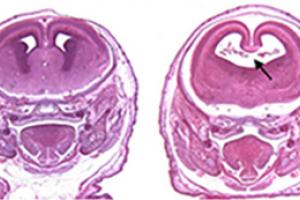 Stained sections of fetal mouse brains.  (Left) Control. (Right) Mouse exposed to alcohol and a cannabinoid on the 8th day of pregnancy. Black arrow highlights enlarged cerebral ventricle caused by the loss of the midline septal region. (Dr. Scott Parnell, UNC Chapel Hill)