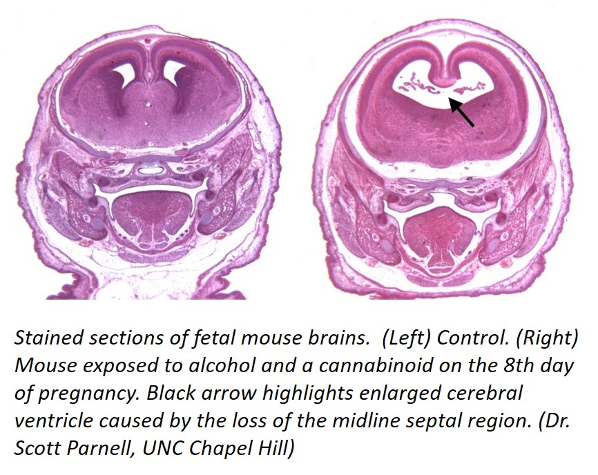 Stained sections of fetal mouse brains.  (Left) Control. (Right) Mouse exposed to alcohol and a cannabinoid on the 8th day of pregnancy. Black arrow highlights enlarged cerebral ventricle caused by the loss of the midline septal region. (Dr. Scott Parnell, UNC Chapel Hill)