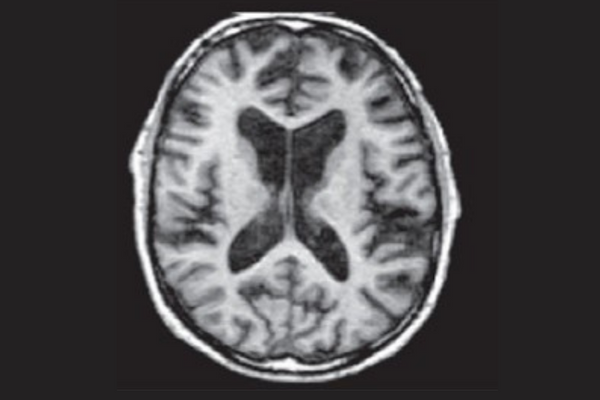 Image of a human male brain with Wernicke-Korsakoff syndrome. The WK brain has less brain volume and larger cavities within the brain (called ventricles) compared to a healthy brain.