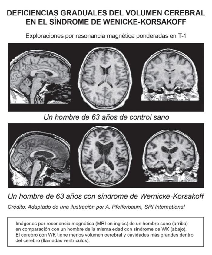 Graded brain-volume deficits in wernicke-korsakoff syndrome (T1-weighted MRI scans). Three images of brain scans showing a normal brain and three images of brain scans showing wernicke-korsakoff syndrome..