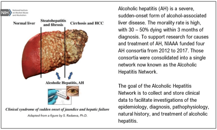 Cirrhosis and HCC liver with Alcoholic hepatitis (AH)